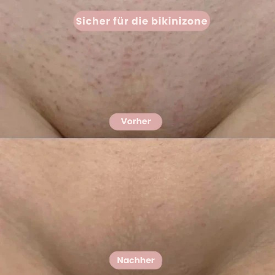 SilkySkin – Intimrasur ohne Hautirritationen